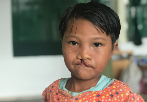 口唇裂の子どもの画像