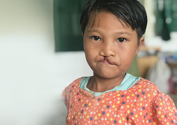 子ども 口唇口蓋裂 寄付