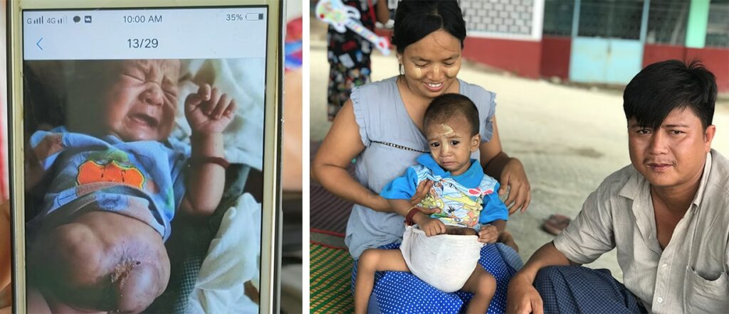 【ご支援受付中】  医療崩壊中のミャンマーから2才の男の子を移送・手術へ